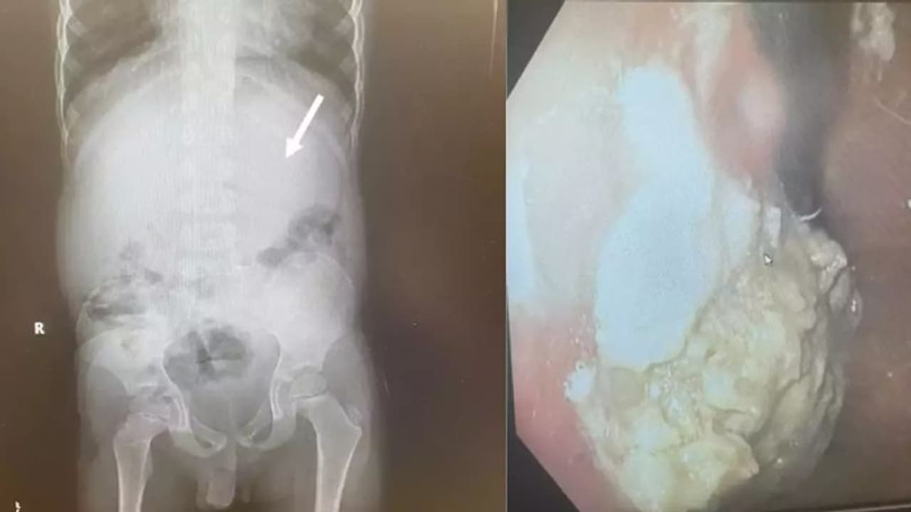 പതിവായി ച്യൂയിങ് ഗം വിഴുങ്ങി; ഒടുവില്‍ അഞ്ച് വയസുകാരന് സംഭവിച്ചത്...