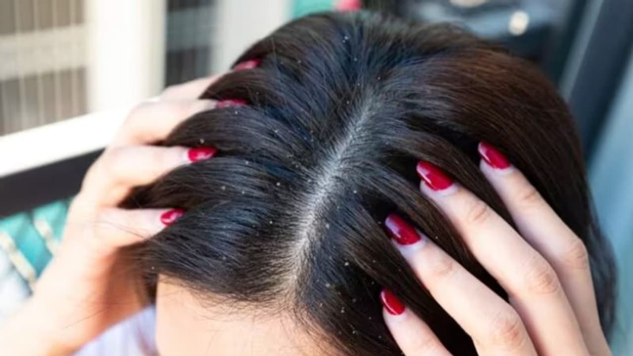 താരൻ അകറ്റാൻ ഇതാ ഏഴ് കിടിലന്‍ ഹെയര്‍ മാസ്കുകള്‍...