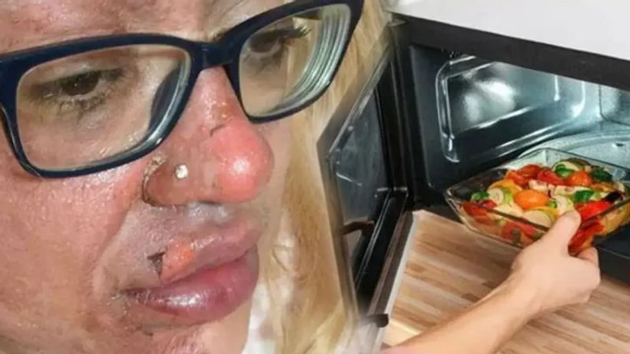 ಮೈಕ್ರೋವೇವ್​ನಲ್ಲಿ ಮೊಟ್ಟೆ ಬೇಯಿಸೋಕೆ ಹೋಗಿ ಮುಖಾನೇ ಸುಟ್ಟೋಯ್ತು!