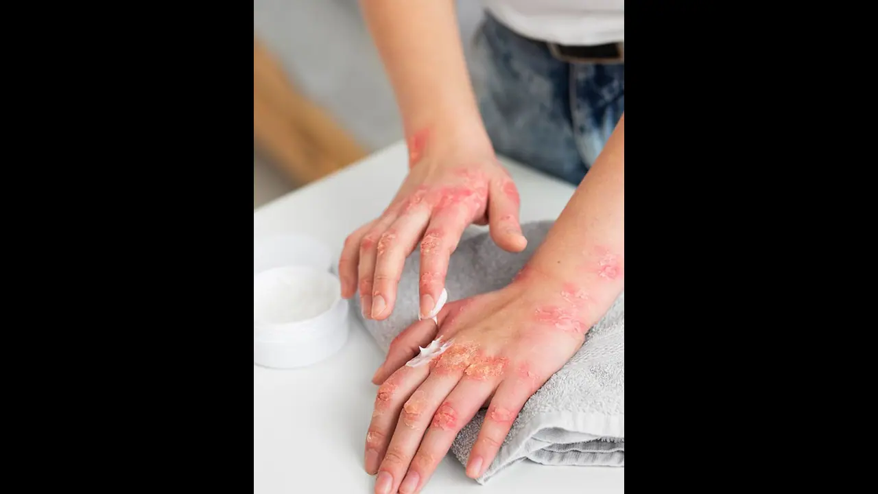 Here are 10 ways to avoid skin rashes during monsoon Here are 10 ways to avoid skin rashes during monsoon