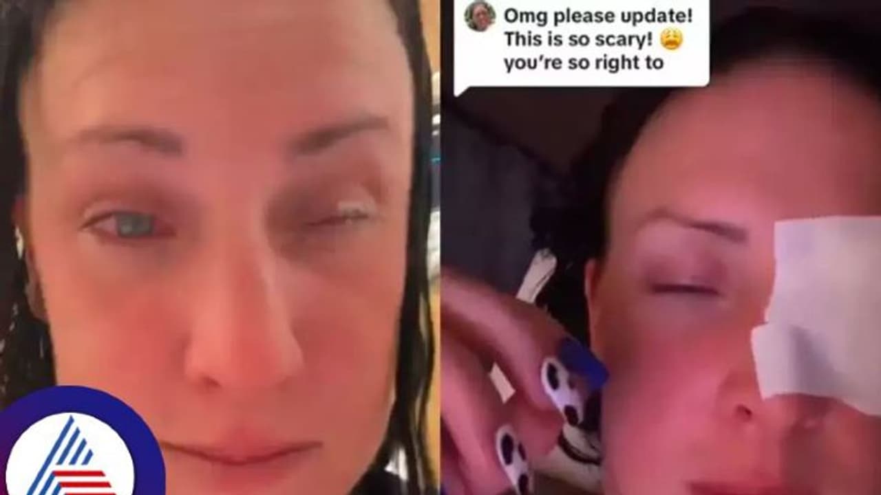 ಐಡ್ರಾಪ್ಸ್‌ ಬದಲು ಕಣ್ಣಿಗೆ ಗಮ್ ಸುರಿದ ಮಹಿಳೆ, ರೆಪ್ಪೆ ಅಂಟಿಕೊಂಡು ಆಸ್ಪತ್ರೆಯಲ್ಲಿ ಒದ್ದಾಟ!