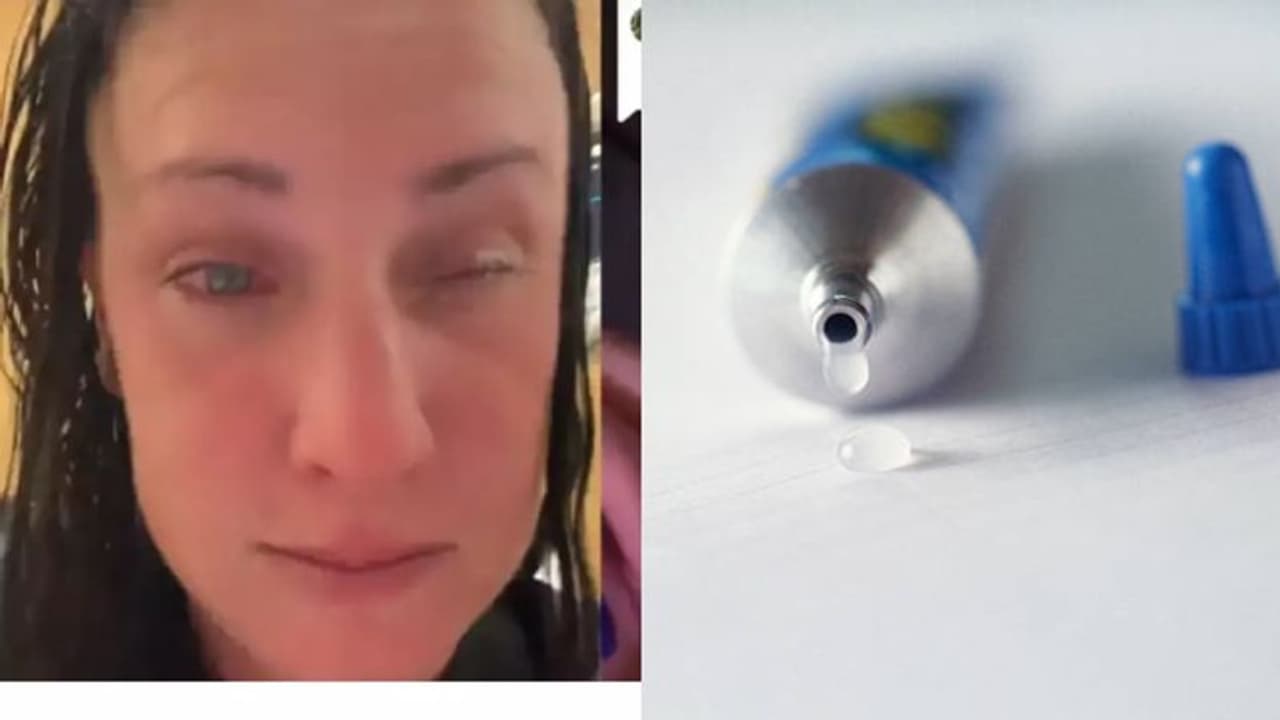 കണ്ണിലിറ്റിക്കുന്ന മരുന്നാണെന്ന് കരുതി സൂപ്പര്‍ഗ്ലൂ ഒഴിച്ചു; യുവതിക്ക് സംഭവിച്ചത്...