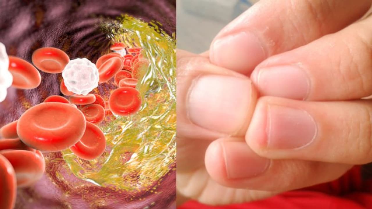 Health Tips: ചീത്ത കൊളസ്ട്രോളിന്റെ ഈ ലക്ഷണങ്ങള് അറിയാതെ പോകരുത്... Health Tips: ചീത്ത കൊളസ്ട്രോളിന്റെ ഈ ലക്ഷണങ്ങള് അറിയാതെ പോകരുത്...