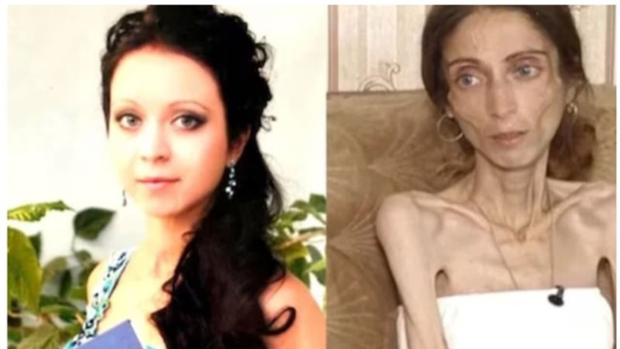 'ചീര്ത്ത കവിളെ'ന്ന് പരിഹാസം; 22 കിലോ കുറച്ച യുവതി ആശുപത്രിയില്, പിന്നാലെ ഭര്ത്താവും ഉപേക്ഷിച്ചു! 'ചീര്ത്ത കവിളെ'ന്ന് പരിഹാസം; 22 കിലോ കുറച്ച യുവതി ആശുപത്രിയില്, പിന്നാലെ ഭര്ത്താവും ഉപേക്ഷിച്ചു!