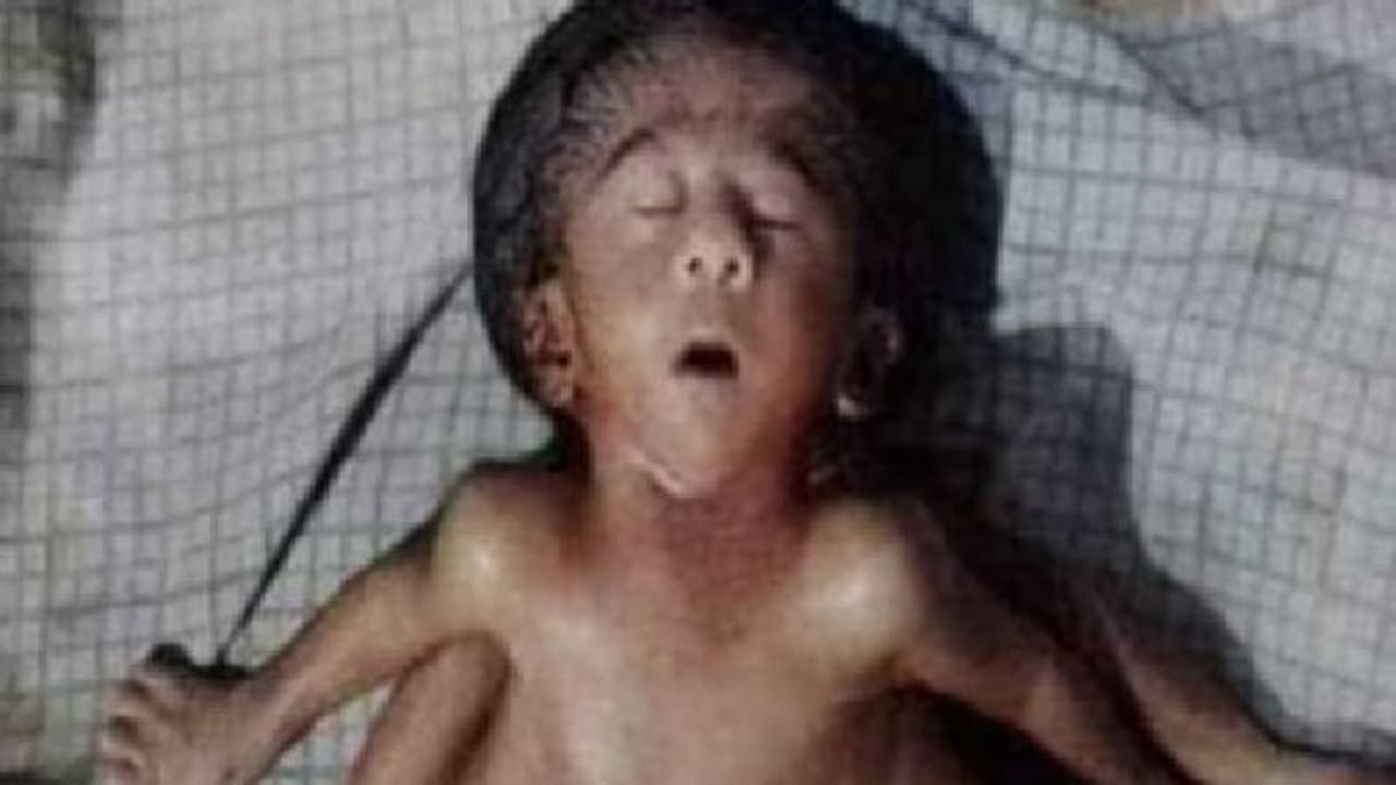 നാല് കൈകളും നാല് കാലുകളുമായി കുഞ്ഞ്, കാണാൻ നഴ്സിങ് ഹോമിന് മുന്നിൽ ജനക്കൂട്ടം