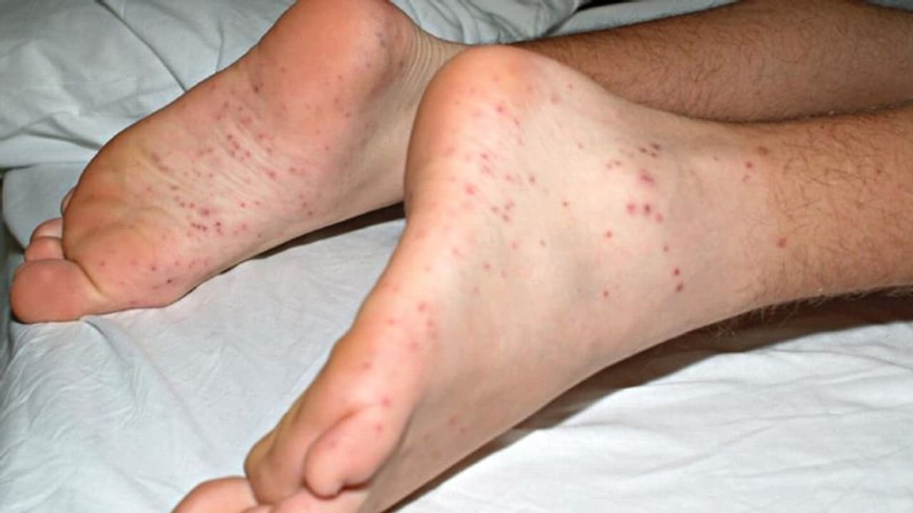 കേരളത്തില്‍ എലിപ്പനിയും ഡെങ്കിപ്പനിയും; തിരിച്ചറിയൂ ഈ ലക്ഷണങ്ങളിലൂടെ