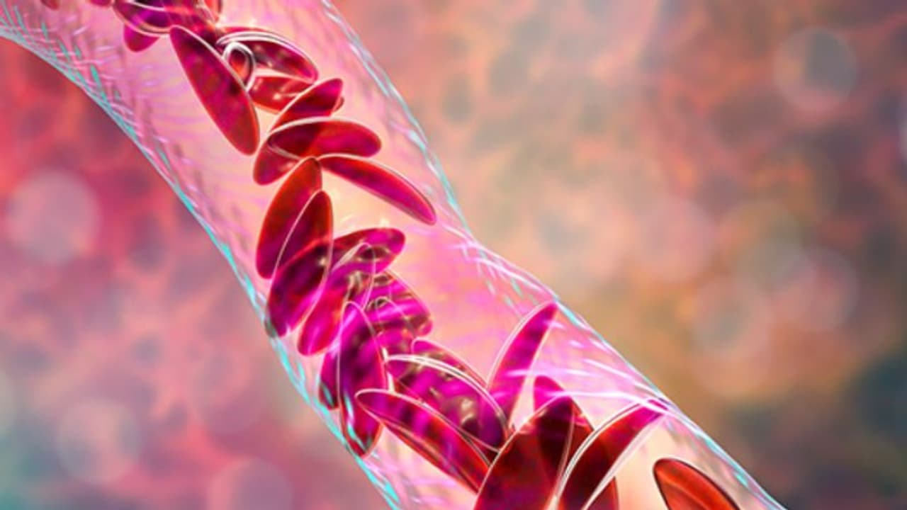  സിക്കിൾ സെൽ ഡിസീസ്; തിരിച്ചറിയാം ഈ ലക്ഷണങ്ങളെ...