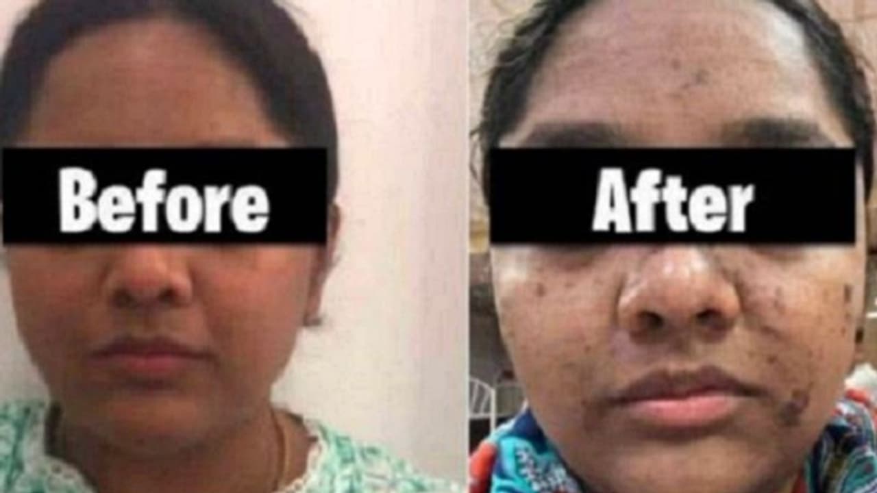 17,500 ರೂ. ಕೊಟ್ಟು ಮುಖಕ್ಕೆ ಫೇಶಿಯಲ್ ಮಾಡಿಸಿಕೊಂಡ ಮಹಿಳೆಯ ಮುಖವೇ ಸುಟ್ಟೋಯ್ತು! 17,500 ರೂ. ಕೊಟ್ಟು ಮುಖಕ್ಕೆ ಫೇಶಿಯಲ್ ಮಾಡಿಸಿಕೊಂಡ ಮಹಿಳೆಯ ಮುಖವೇ ಸುಟ್ಟೋಯ್ತು!