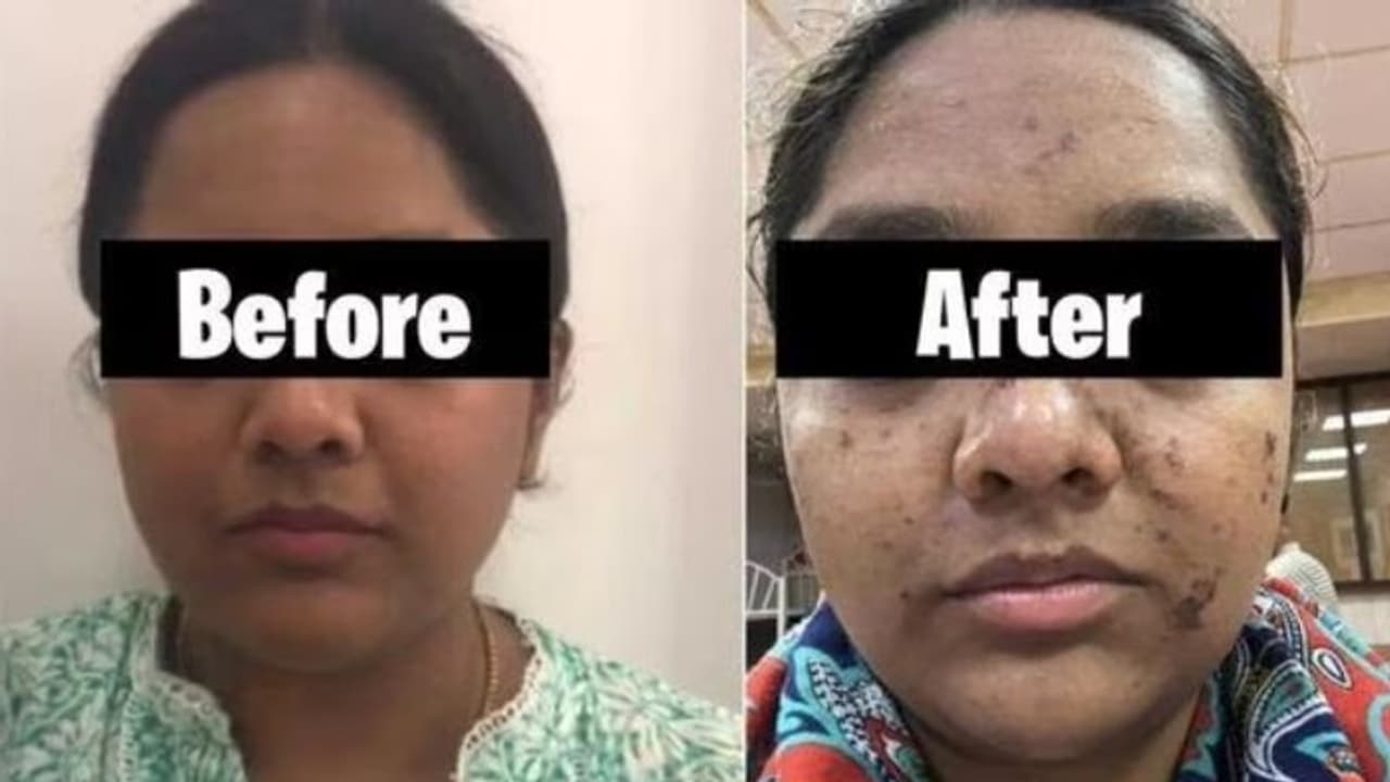 17,000 രൂപയുടെ ഫേഷ്യല് ചെയ്ത് മുഖം പൊള്ളി; സലൂണിനെതിരെ കേസ് 17,000 രൂപയുടെ ഫേഷ്യല് ചെയ്ത് മുഖം പൊള്ളി; സലൂണിനെതിരെ കേസ്