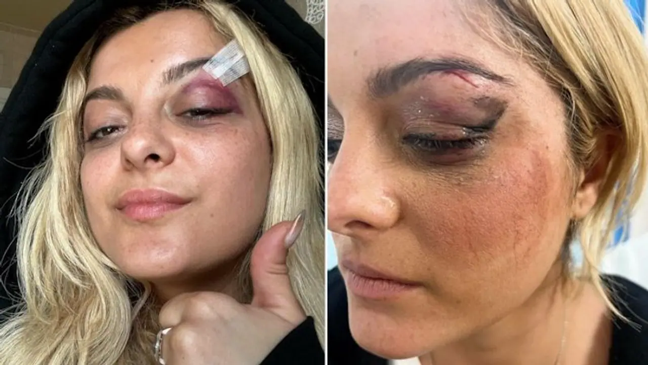 Bebe Rexha suffers head injury after fan hurls phone at her during NYC concert, watch video 