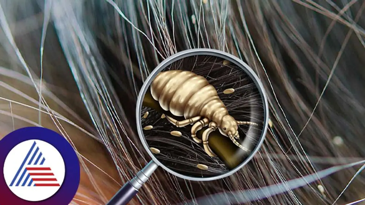 Hair Care : ಕೊಳಕಿನ ಕಾರಣ ಬಿಟ್ಟು, ತಲೇಲಿ ಹೇನು ಆಗೋಕೆ ಬೇರೆ ಕಾರಣವಿದ್ಯಾ?