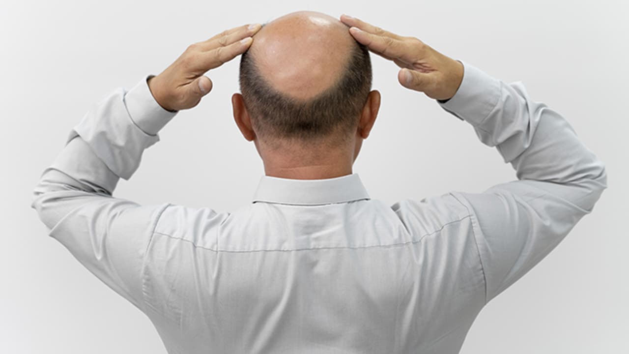 Hair loss in Male Hair loss in Male