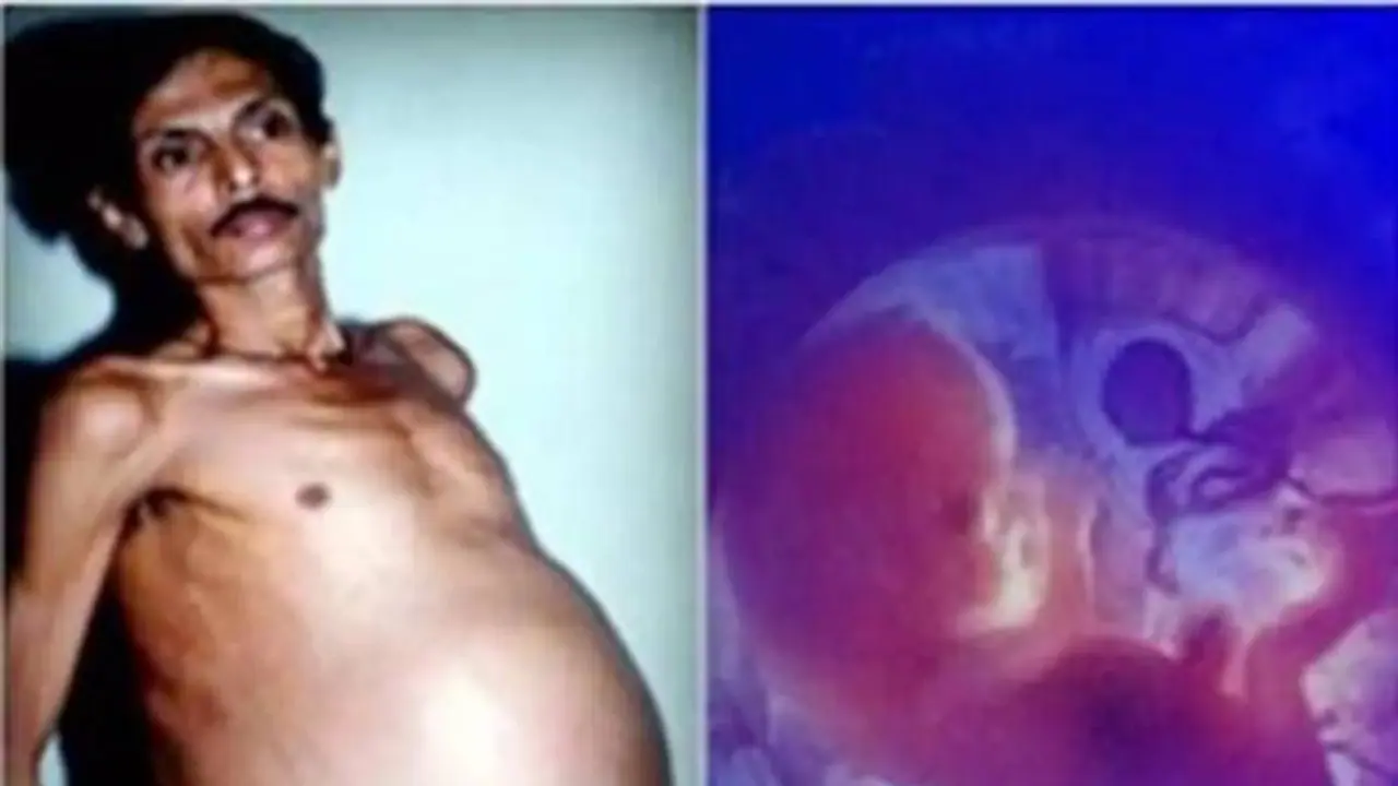 அரிதினும் அரிய நிகழ்வு.. 36 ஆண்டுகளாக இரட்டை குழந்தையுடன் வாழ்ந்த நபர்.. வியப்பில் ஆழந்த மருத்துவர்கள்