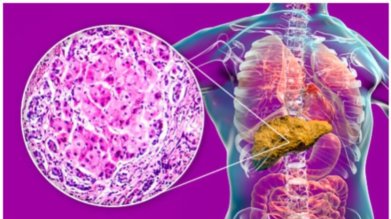 Health Tips : കരളില് കൊഴുപ്പ് അടിഞ്ഞുകൂടുന്നത് തടയാൻ ആറ് കാര്യങ്ങൾ ശ്രദ്ധിക്കാം Health Tips : കരളില് കൊഴുപ്പ് അടിഞ്ഞുകൂടുന്നത് തടയാൻ ആറ് കാര്യങ്ങൾ ശ്രദ്ധിക്കാം