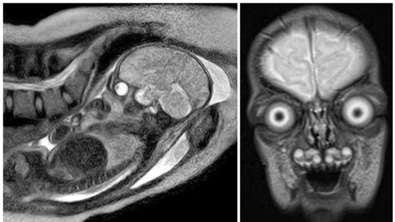 അന്യഗ്രഹ ജീവിയോ? മനുഷ്യഭ്രൂണമോ? ഗര്ഭപിണ്ഡത്തിന്റെ എംആര്ഐ സ്കാനിംഗില് ലഭിച്ചത് ഭയപ്പെടുത്തുന്ന ചിത്രങ്ങള്! അന്യഗ്രഹ ജീവിയോ? മനുഷ്യഭ്രൂണമോ? ഗര്ഭപിണ്ഡത്തിന്റെ എംആര്ഐ സ്കാനിംഗില് ലഭിച്ചത് ഭയപ്പെടുത്തുന്ന ചിത്രങ്ങള്!