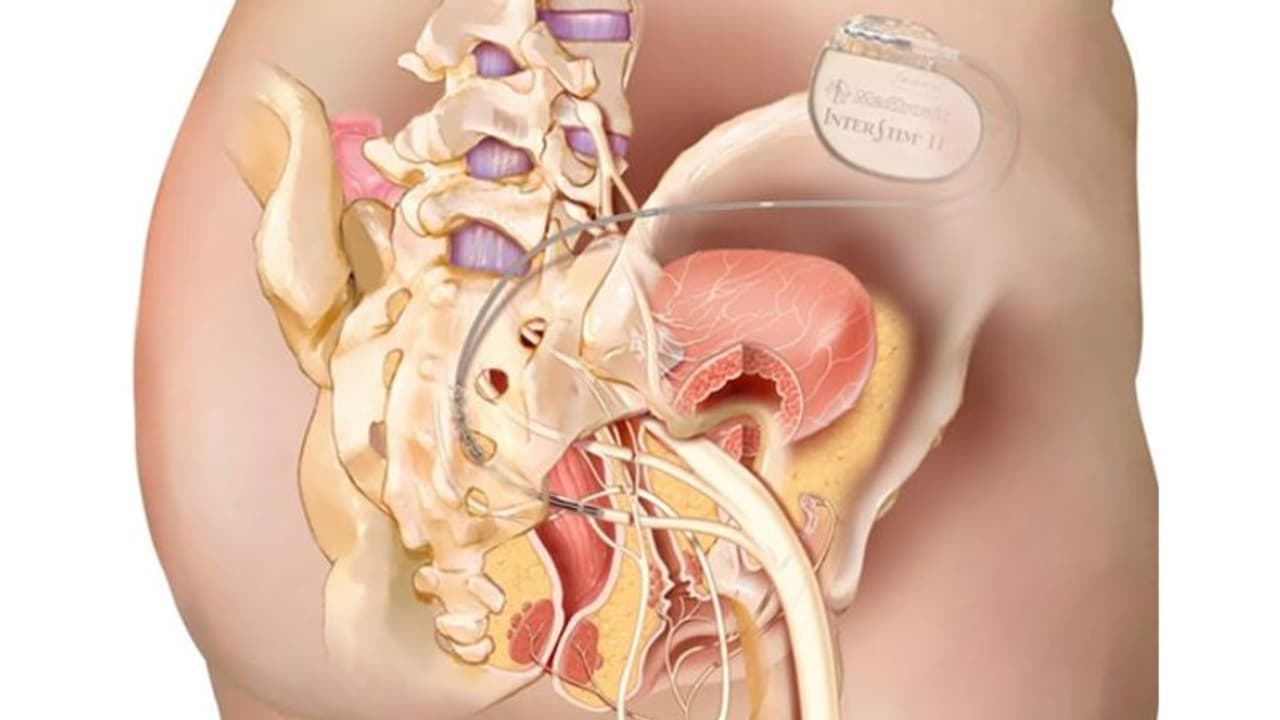 ഓവർ ആക്ടീവ് ബ്ലാഡർ രോഗം ശസ്ത്രക്രിയയിലൂടെ പരിഹരിച്ച് ആസ്റ്റർ മെഡ്സിറ്റി ഓവർ ആക്ടീവ് ബ്ലാഡർ രോഗം ശസ്ത്രക്രിയയിലൂടെ പരിഹരിച്ച് ആസ്റ്റർ മെഡ്സിറ്റി