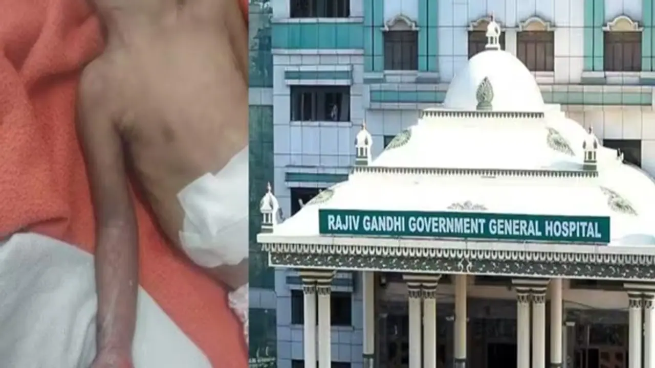 குழந்தை கை இழந்த விவகாரம்: விசாரணை அறிக்கை வெளியீடு! குழந்தை கை இழந்த விவகாரம்: விசாரணை அறிக்கை வெளியீடு!