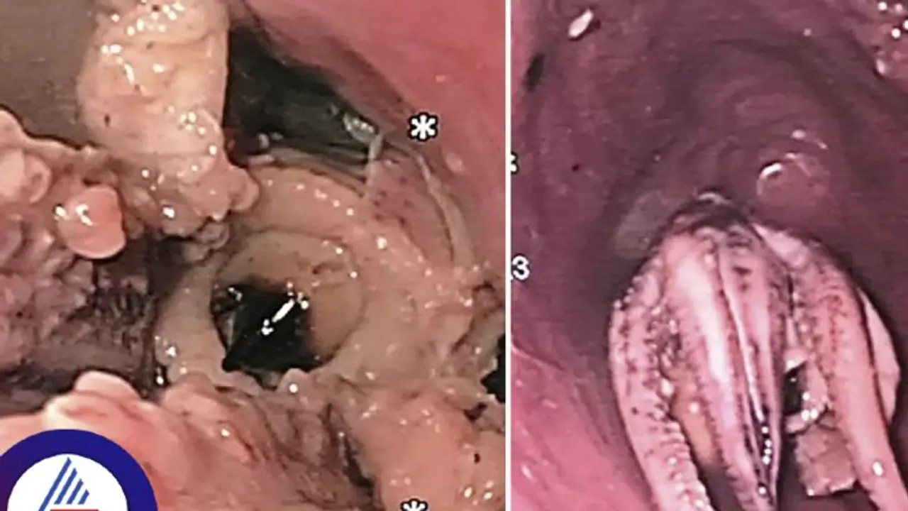ವ್ಯಾಕ್ ವ್ಯಾಕ್ ಅಂತ ದಿನಪೂರ್ತಿ ವಾಂತಿ ಮಾಡ್ತಿದ್ದ, ಗಂಟಲು ಟೆಸ್ಟ್ ಮಾಡಿದ ವೈದ್ಯರೇ ಬೆಚ್ಚಿಬಿದ್ರು! ವ್ಯಾಕ್ ವ್ಯಾಕ್ ಅಂತ ದಿನಪೂರ್ತಿ ವಾಂತಿ ಮಾಡ್ತಿದ್ದ, ಗಂಟಲು ಟೆಸ್ಟ್ ಮಾಡಿದ ವೈದ್ಯರೇ ಬೆಚ್ಚಿಬಿದ್ರು!