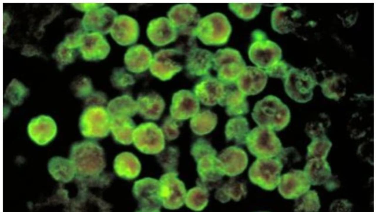 ആലപ്പുഴയിൽ അപൂർവ്വ രോഗം ബാധിച്ച 15കാരൻ മരിച്ചു, ജാഗ്രത വേണം ആലപ്പുഴയിൽ അപൂർവ്വ രോഗം ബാധിച്ച 15കാരൻ മരിച്ചു, ജാഗ്രത വേണം