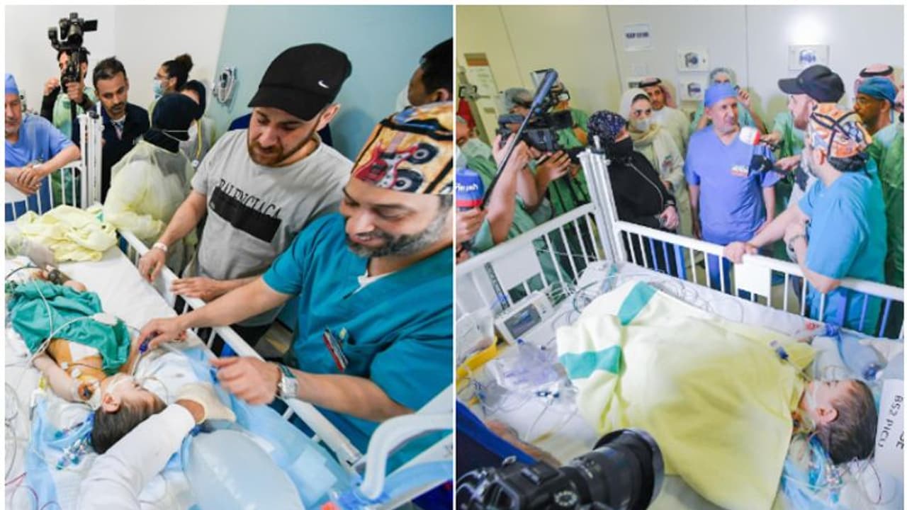  ഏഴര മണിക്കൂർ നീണ്ട ശസ്ത്രക്രിയ; സിറിയൻ സയാമീസുകളെ സൗദിയിൽ വിജയകരമായി വേർപെടുത്തി