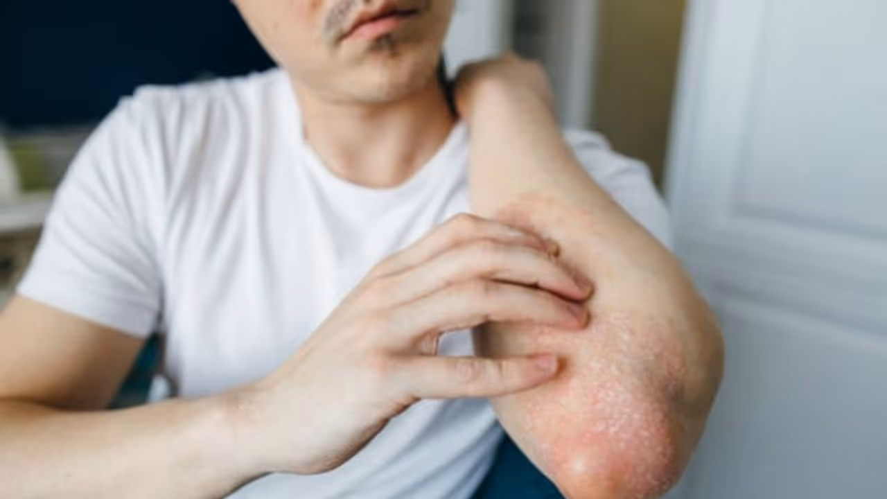 മഴക്കാലത്തെ ഫംഗല്‍ അണുബാധകള്‍ ഒഴിവാക്കാൻ ചെയ്യേണ്ടത്... 