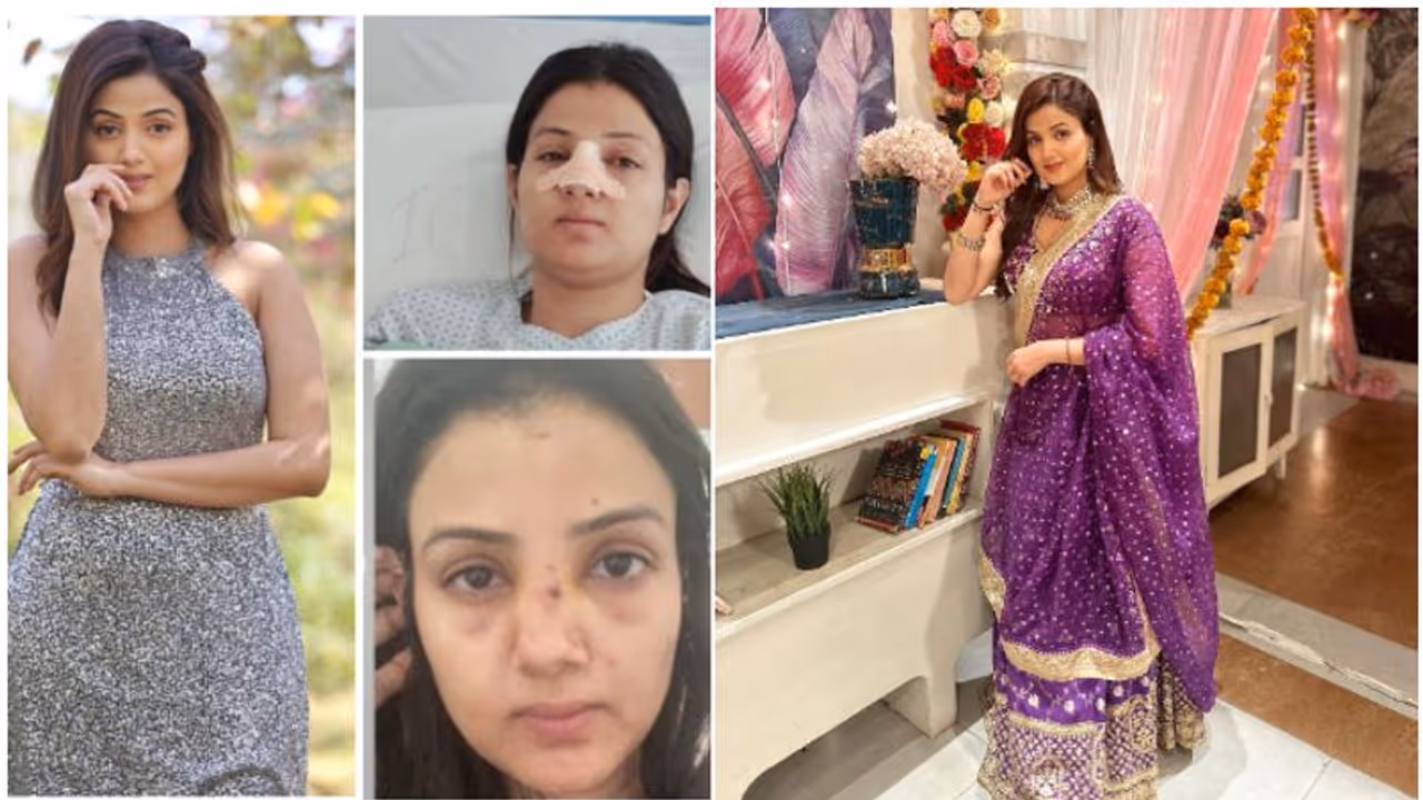 Actress Sumati Singh talks about her emotional distress after nose surgery Actress Sumati Singh talks about her emotional distress after nose surgery