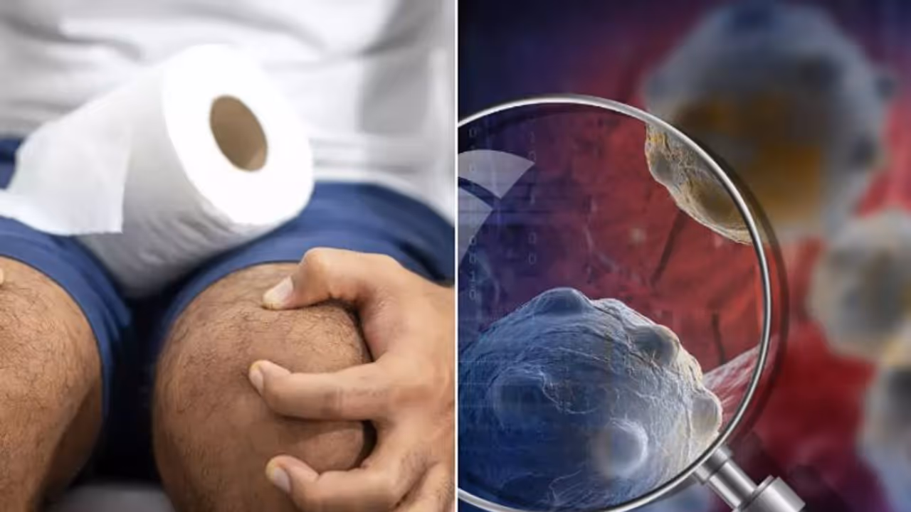 മലദ്വാരത്തിലെ ക്യാൻസര്‍; ശ്രദ്ധിക്കാതെ പോകുന്ന ലക്ഷണങ്ങള്‍...