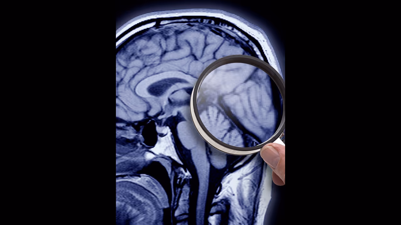 ഇത് ചരിത്രം; അല്ഷിമേഴ്സ് രോഗത്തിനുള്ള മരുന്ന് വരുന്നു... ഇത് ചരിത്രം; അല്ഷിമേഴ്സ് രോഗത്തിനുള്ള മരുന്ന് വരുന്നു...