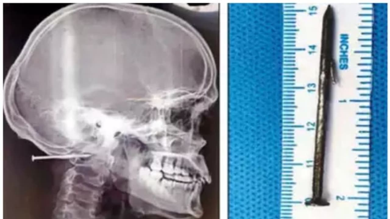 അസഹനീയമായ വേദന; സഹപ്രവര്ത്തകന്റെ ഗണ്ണില് നിന്ന് അബദ്ധത്തില് ഉതിര്ന്ന ആണി യുവാവിന്റെ തലയില് തുളഞ്ഞുകയറി അസഹനീയമായ വേദന; സഹപ്രവര്ത്തകന്റെ ഗണ്ണില് നിന്ന് അബദ്ധത്തില് ഉതിര്ന്ന ആണി യുവാവിന്റെ തലയില് തുളഞ്ഞുകയറി