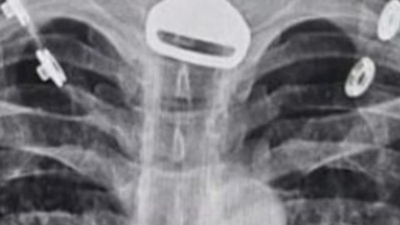 കടുത്ത ശ്വാസംമുട്ട്, 49 കാരനെ ആശുപത്രിയിലെത്തിച്ചു; പരിശോധനക്കിടെ എക്സ് റേ എടുത്തപ്പോൾ ഞെട്ടി ഡോക്ടര്മാര് ! കടുത്ത ശ്വാസംമുട്ട്, 49 കാരനെ ആശുപത്രിയിലെത്തിച്ചു; പരിശോധനക്കിടെ എക്സ് റേ എടുത്തപ്പോൾ ഞെട്ടി ഡോക്ടര്മാര് !