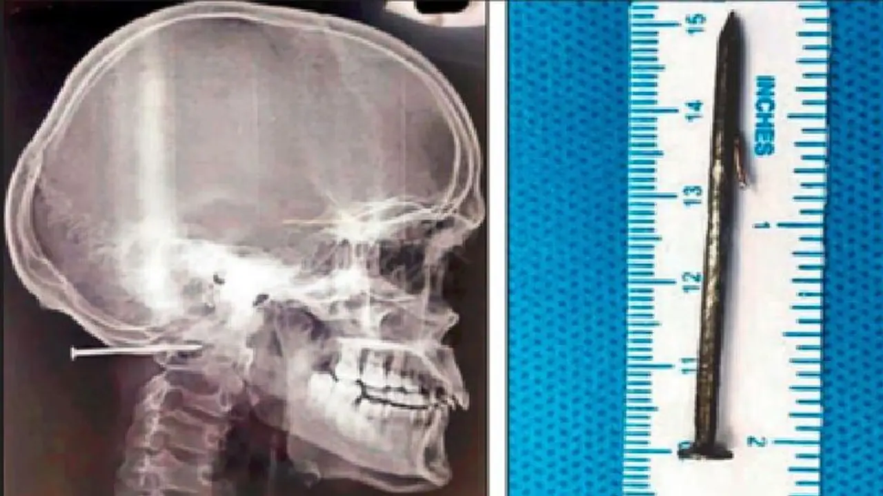 ಕಾರ್ಮಿಕನ ತಲೆ ಹೊಕ್ಕಿದ 2 ಇಂಚು ಉದ್ದದ ಮೊಳೆ : ಡ್ರಿಲ್ ಮಾಡಿ ಹೊರತೆಗೆದ ವೈದ್ಯರು ಕಾರ್ಮಿಕನ ತಲೆ ಹೊಕ್ಕಿದ 2 ಇಂಚು ಉದ್ದದ ಮೊಳೆ : ಡ್ರಿಲ್ ಮಾಡಿ ಹೊರತೆಗೆದ ವೈದ್ಯರು