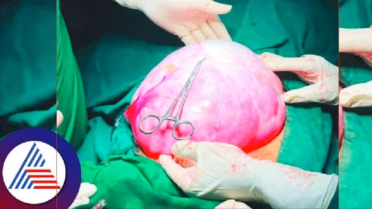 ಬೆಳಗಾವಿ: ಮಹಿಳೆ ಹೊಟ್ಟೆಯಲ್ಲಿದ್ದ 3 ಕೆಜಿ ಗಡ್ಡೆ ತೆಗೆದ ವೈದ್ಯರು! ಬೆಳಗಾವಿ: ಮಹಿಳೆ ಹೊಟ್ಟೆಯಲ್ಲಿದ್ದ 3 ಕೆಜಿ ಗಡ್ಡೆ ತೆಗೆದ ವೈದ್ಯರು!