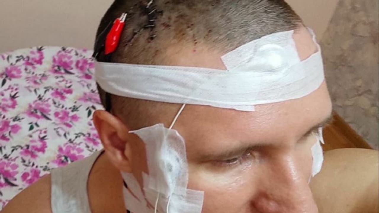 ಯೂಟ್ಯೂಬ್‌ ವಿಡಿಯೋ ನೋಡಿ ಮೆದುಳಿಗೆ ಚಿಪ್‌ ಅಳವಡಿಸಿಕೊಳ್ಳಲು ಸ್ವಯಂ ಆಪರೇಷನ್‌ ಮಾಡ್ಕೊಂಡ ಭೂಪ: ಆಮೇಲೇನಾಯ್ತು ನೋಡಿ.. 