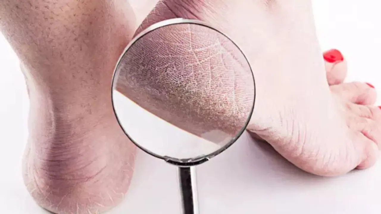 Effective home remedies for cracked heels