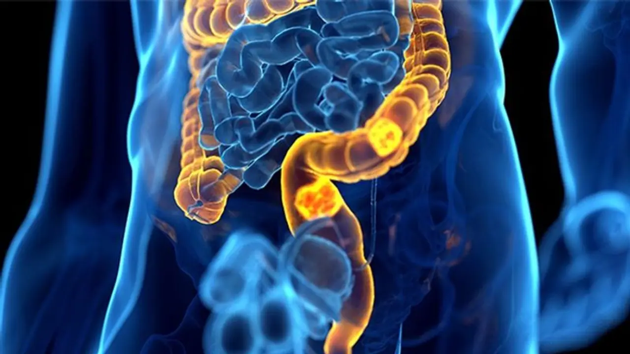 What is Colon Cancer? Know when you should get yourself screened? What is Colon Cancer? Know when you should get yourself screened?