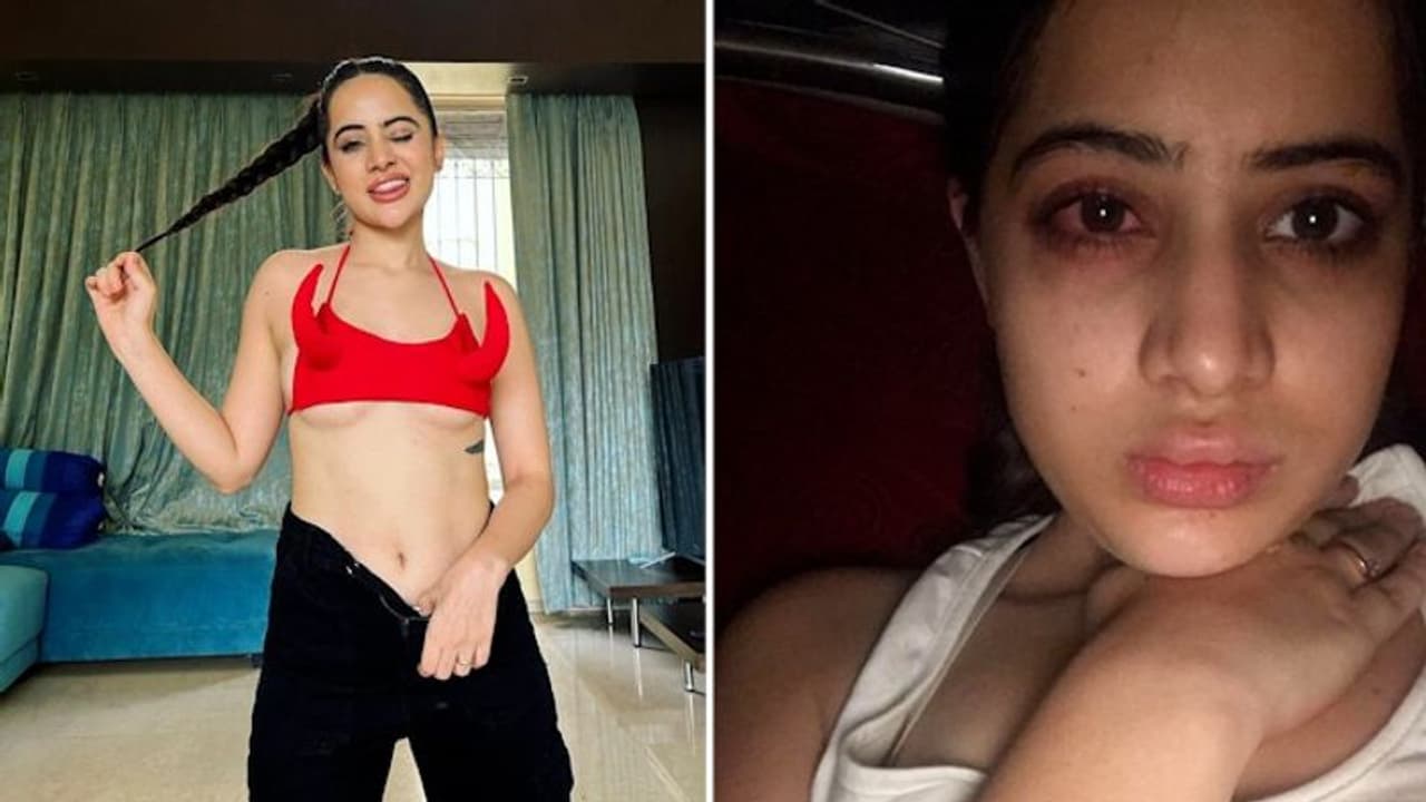 Urfi Javed opens up on her painful 'lip filler' journey; Here's what she said