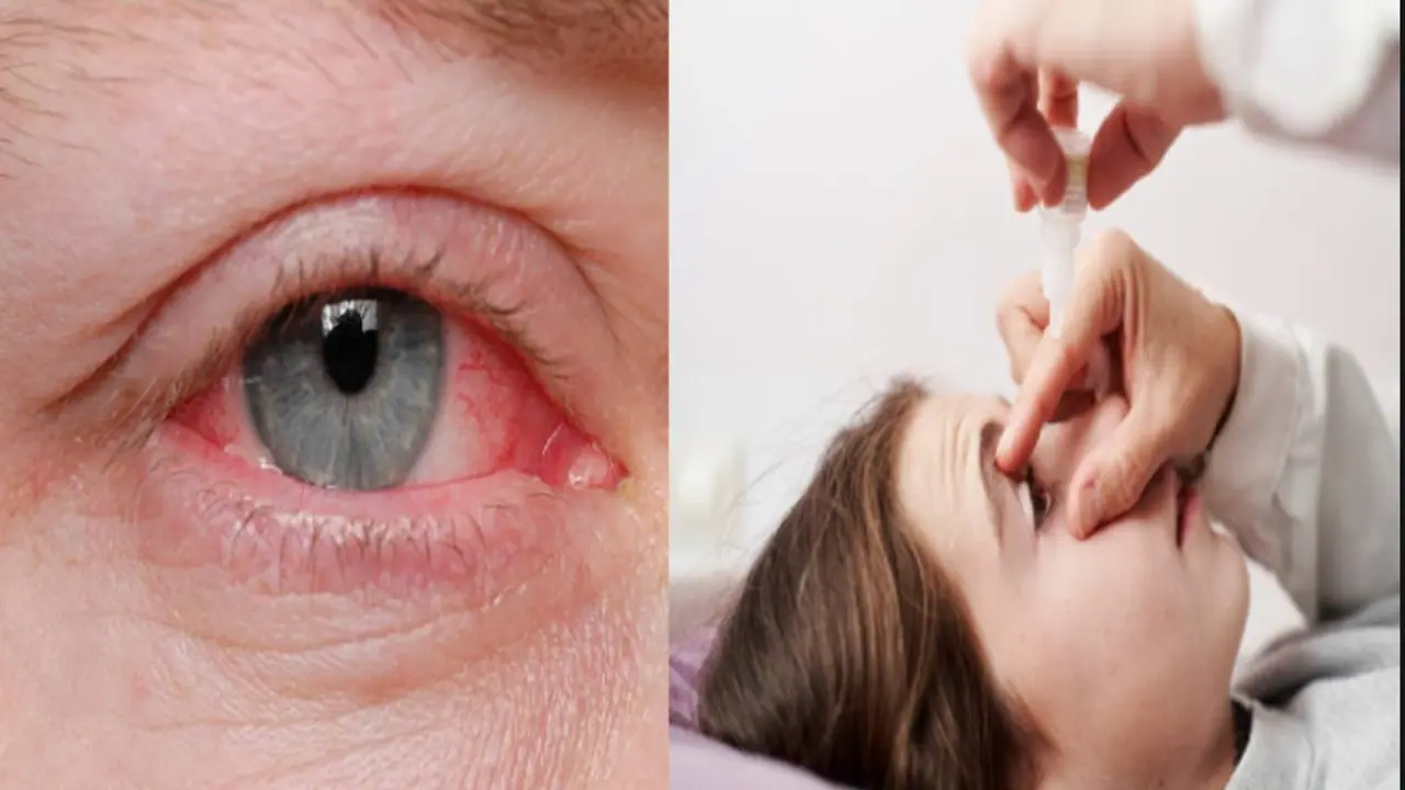 Conjunctivitis
