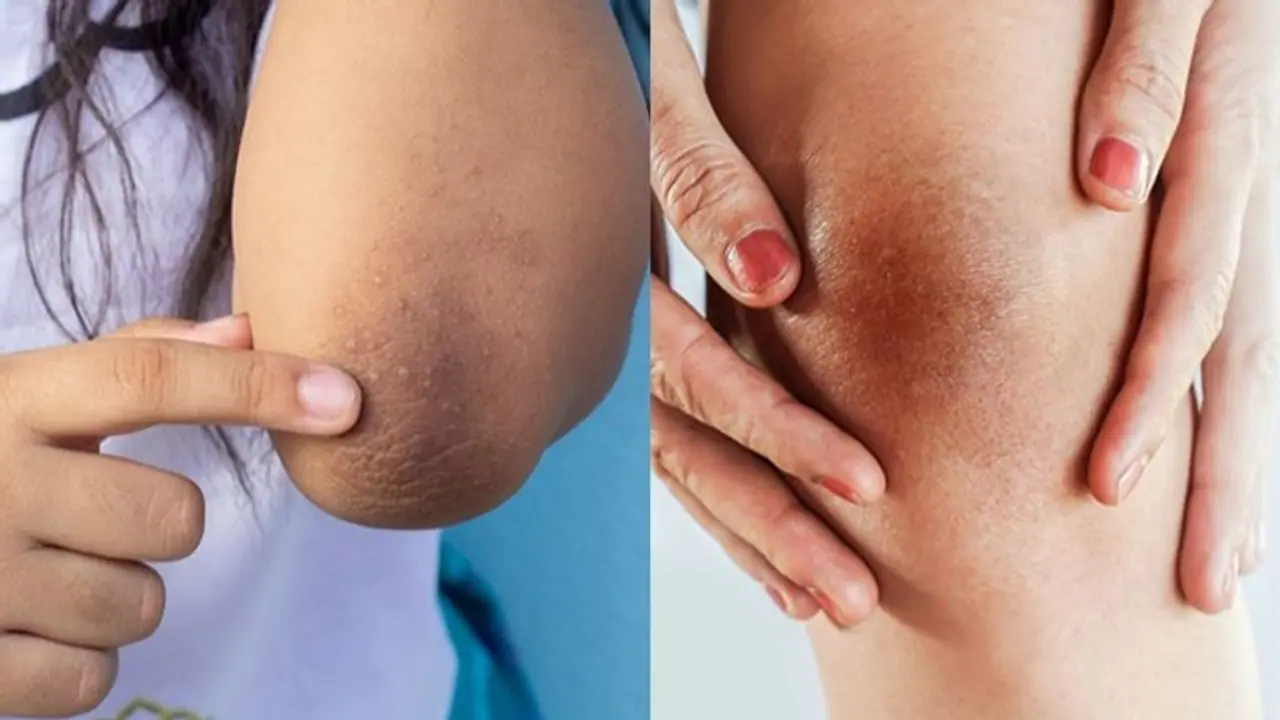 ശരീരത്തിലെ ഇരുണ്ട പാടുകള് അകറ്റാന് വീട്ടില് പരീക്ഷിക്കാം ഈ വഴികള്... ശരീരത്തിലെ ഇരുണ്ട പാടുകള് അകറ്റാന് വീട്ടില് പരീക്ഷിക്കാം ഈ വഴികള്...