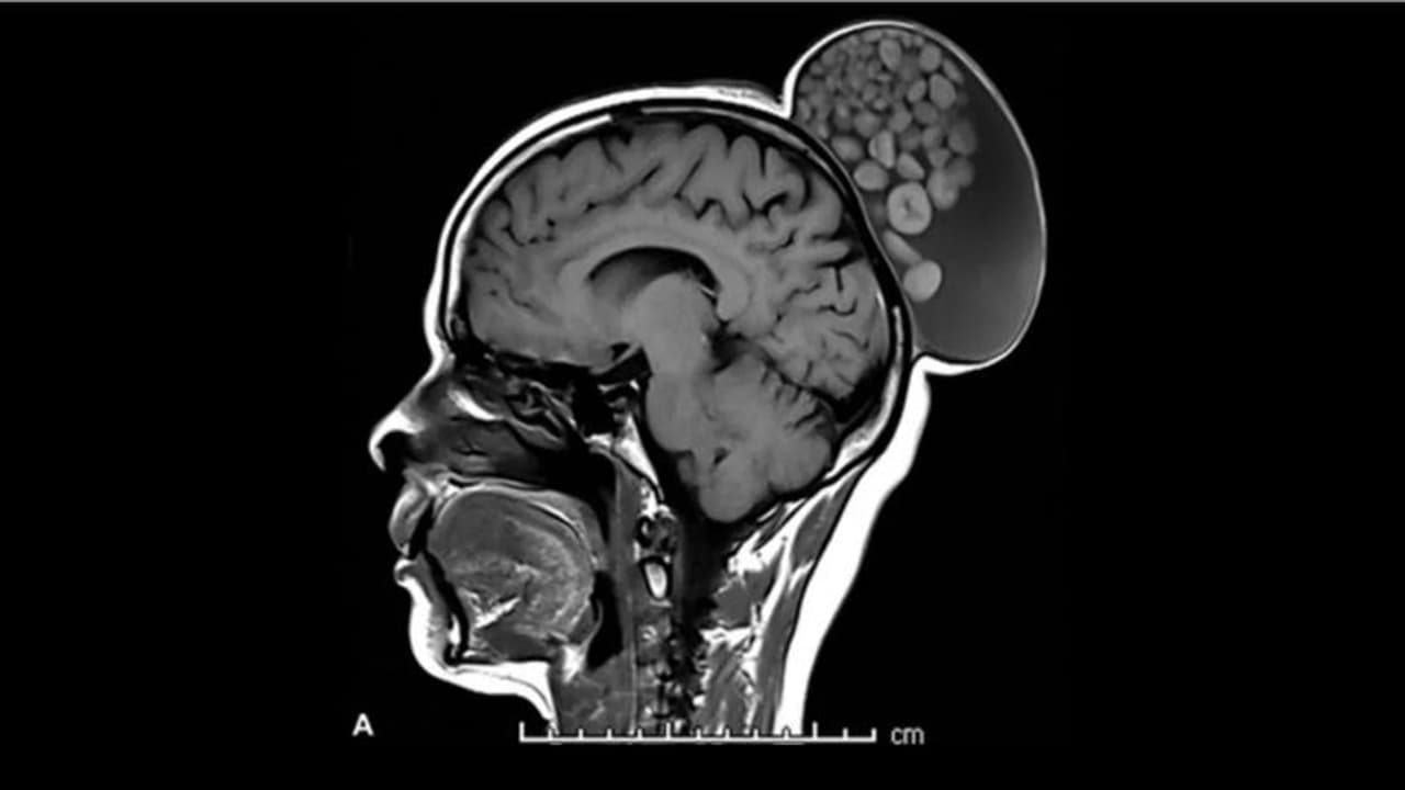 കുട്ടിക്കാലം മുതൽ സ്ത്രീയുടെ തലയിൽ മുഴ, വേദനയില്ല, എംആർഐ സ്കാനിൽ ഉള്ളിൽ കണ്ടത് ഗോളരൂപങ്ങൾ, ശസ്ത്രക്രിയ വിജയം