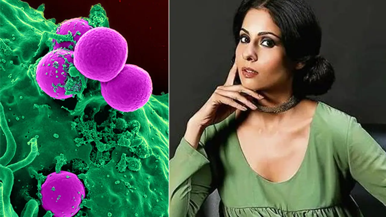 What is costochondritis What is costochondritis