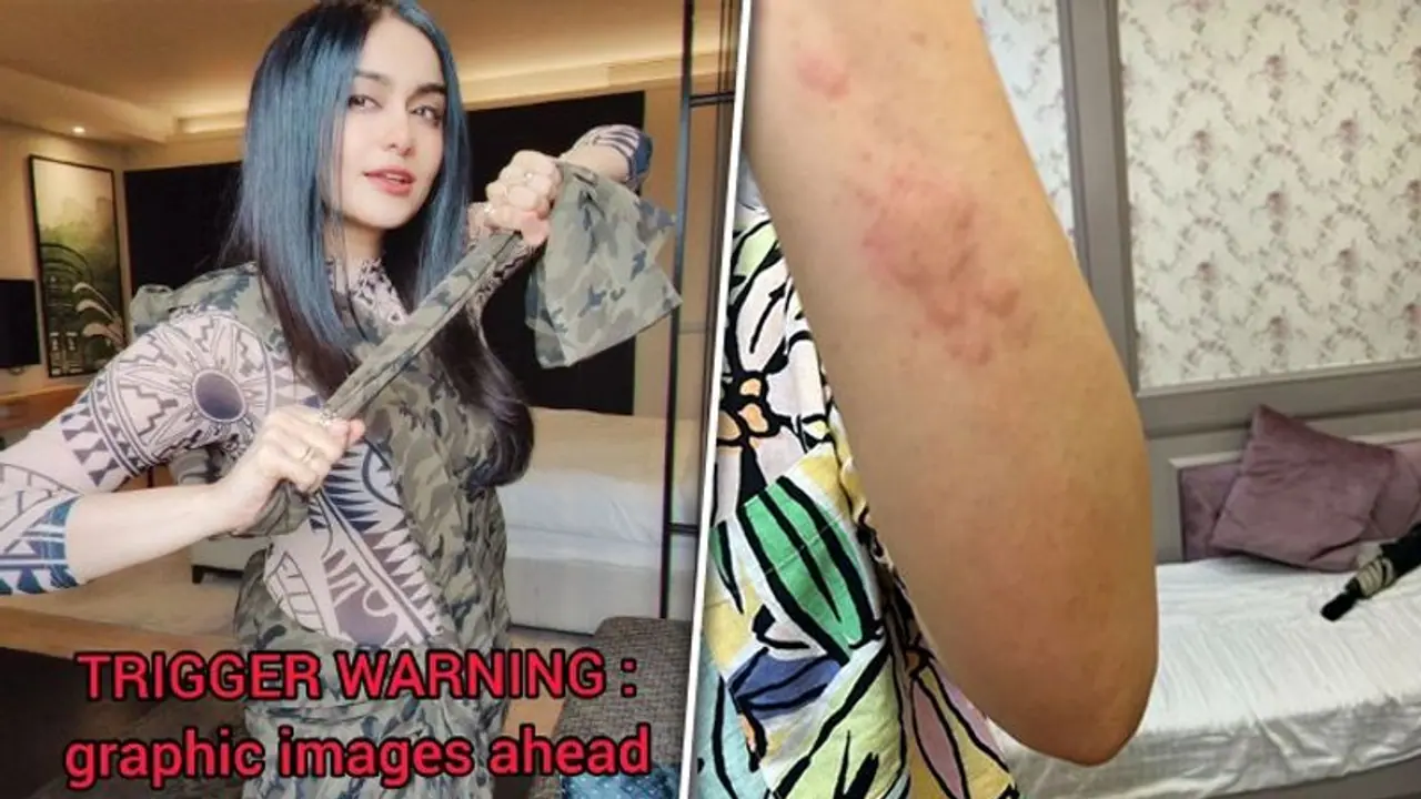 Adah Sharma health update: 'The Kerala Story' actress opts for Ayurvedic treatment horrible rash; shares photo Adah Sharma health update: 'The Kerala Story' actress opts for Ayurvedic treatment horrible rash; shares photo