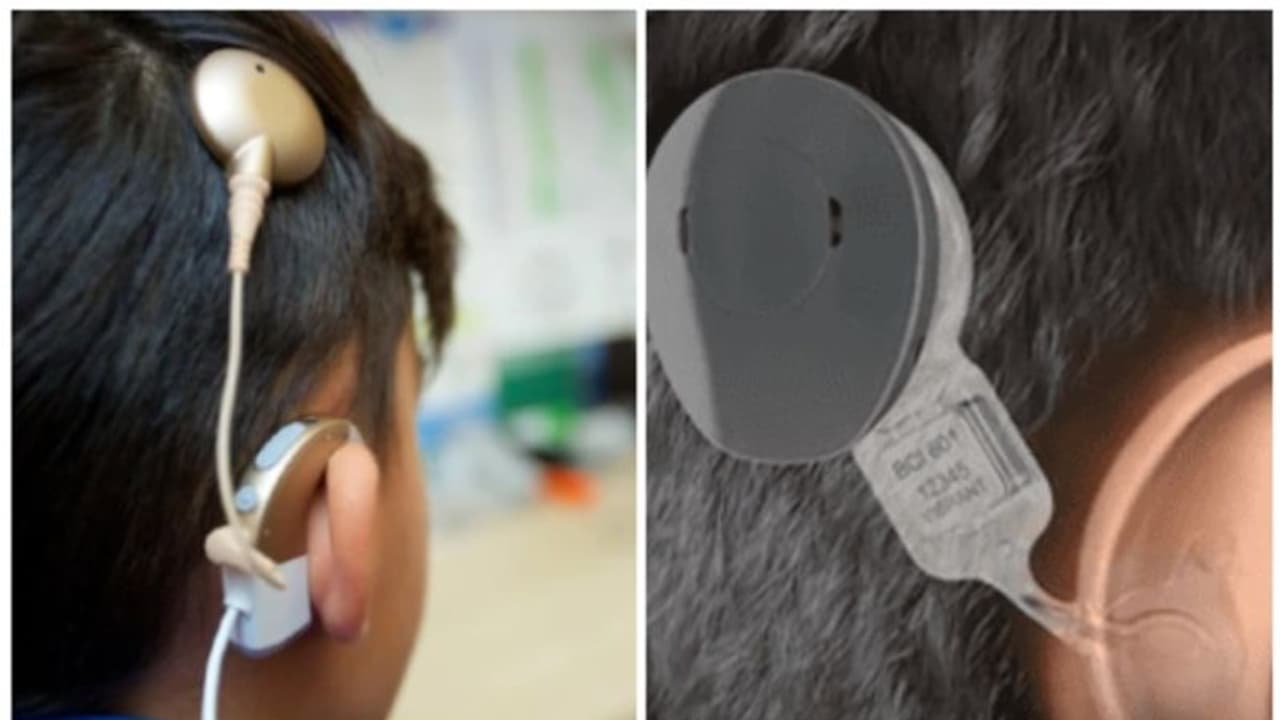  'ശ്രുതിതരംഗം' കൈവിട്ടില്ല, 44 കുട്ടികളുടെ കോക്ലിയര്‍ ഇംപ്ലാന്റേഷന്‍ ശസ്ത്രക്രിയ ഉടൻ