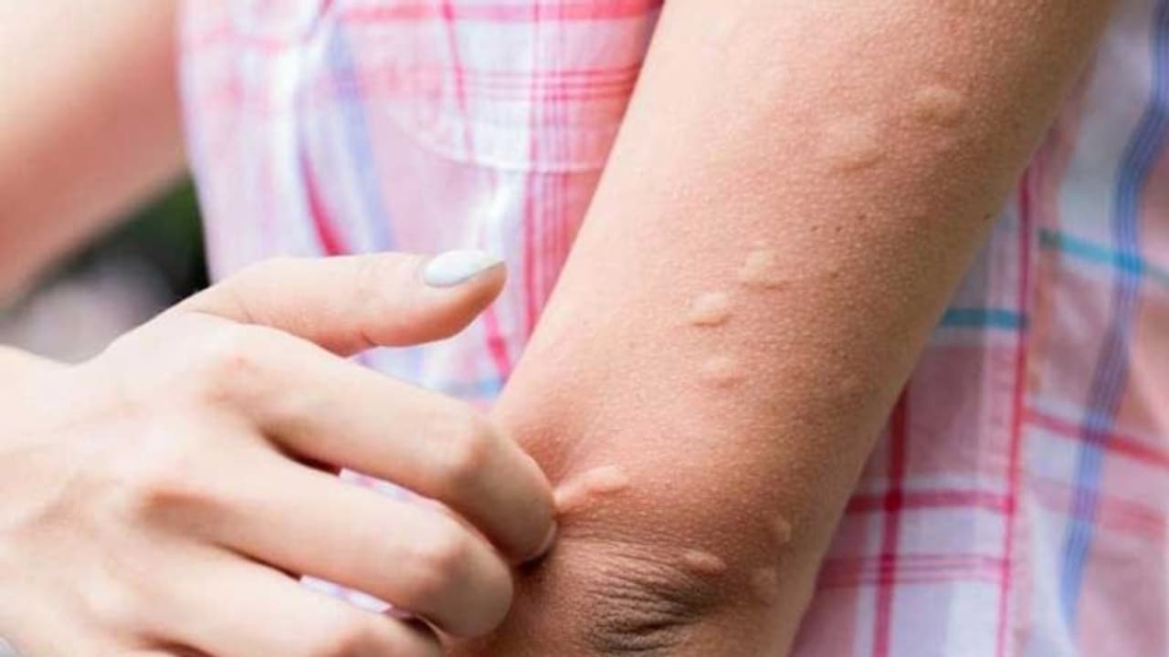 ജാപ്പനീസ് എൻസഫലൈറ്റിസ് ബാധിച്ച് 11 മരണം; അറിയാം ഈ രോഗത്തെ കുറിച്ച്... ജാപ്പനീസ് എൻസഫലൈറ്റിസ് ബാധിച്ച് 11 മരണം; അറിയാം ഈ രോഗത്തെ കുറിച്ച്...