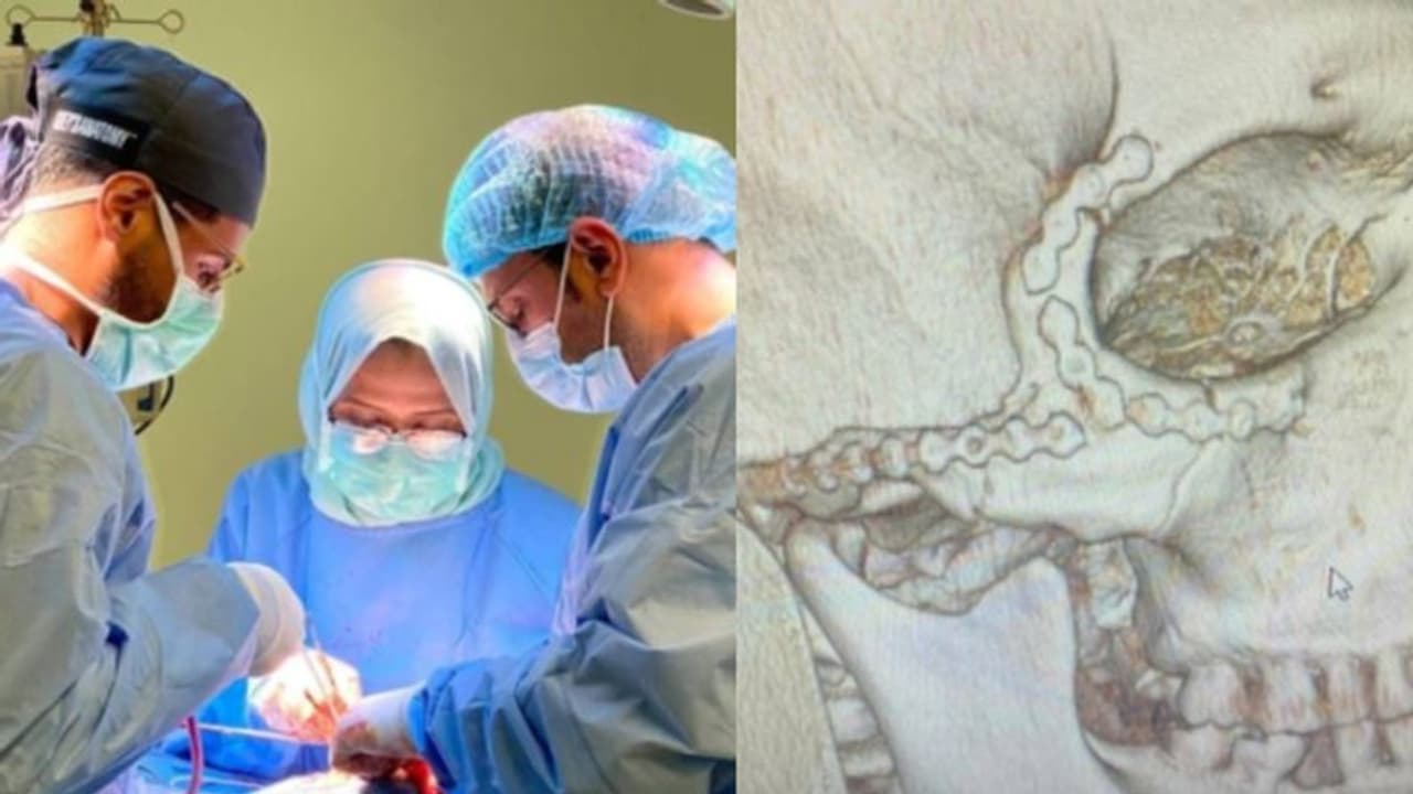 അപകടത്തിൽ പ്രവാസിയുടെ മുഖത്തെ എല്ലിന് ഒന്നിലധികം പൊട്ടലുകൾ, കവിളെല്ലുകൾ പുനർനിർമിച്ച് 4 മണിക്കൂർ ശസ്ത്രക്രിയ