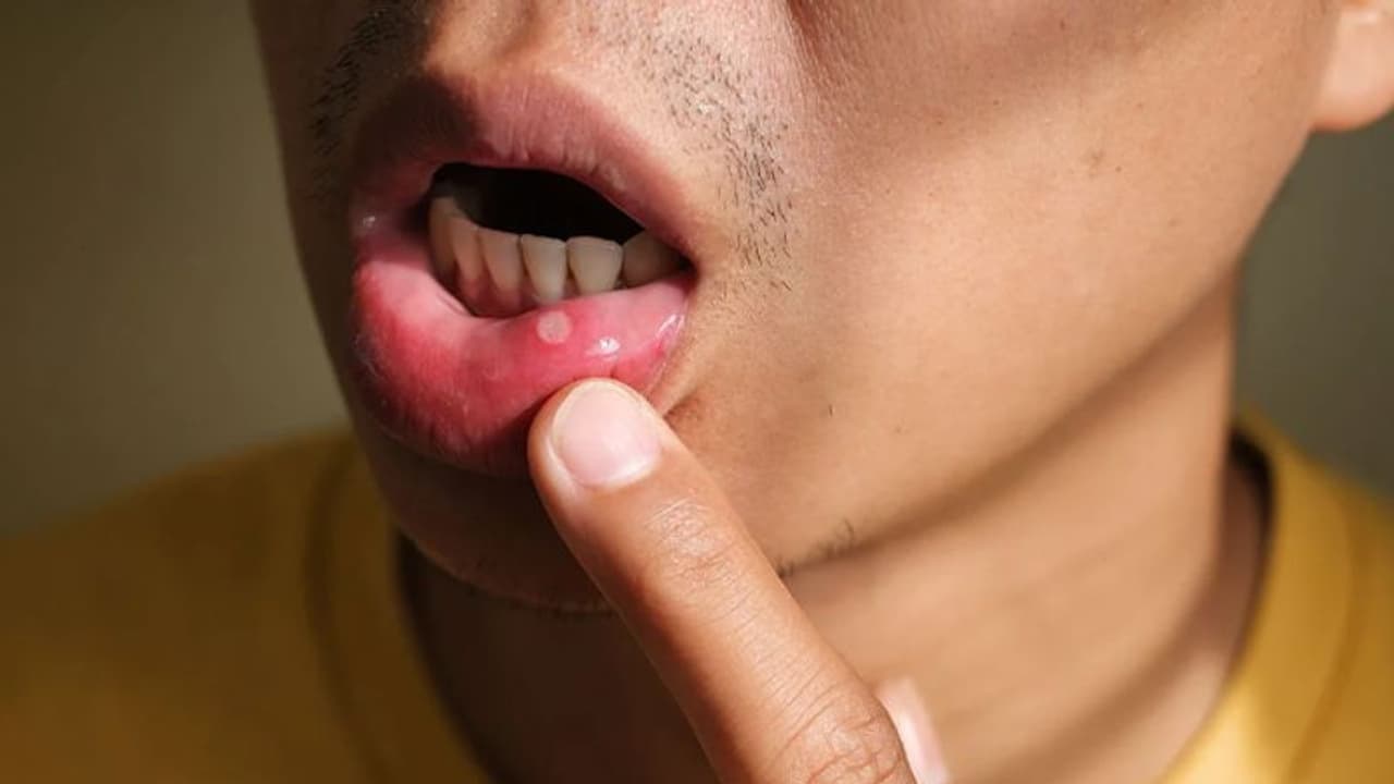 Health Tips: വായ്പ്പുണ്ണ് മൂലം അസഹ്യമായ വേദനയോ? വീട്ടില് പരീക്ഷിക്കാം ഇക്കാര്യങ്ങള്... Health Tips: വായ്പ്പുണ്ണ് മൂലം അസഹ്യമായ വേദനയോ? വീട്ടില് പരീക്ഷിക്കാം ഇക്കാര്യങ്ങള്...