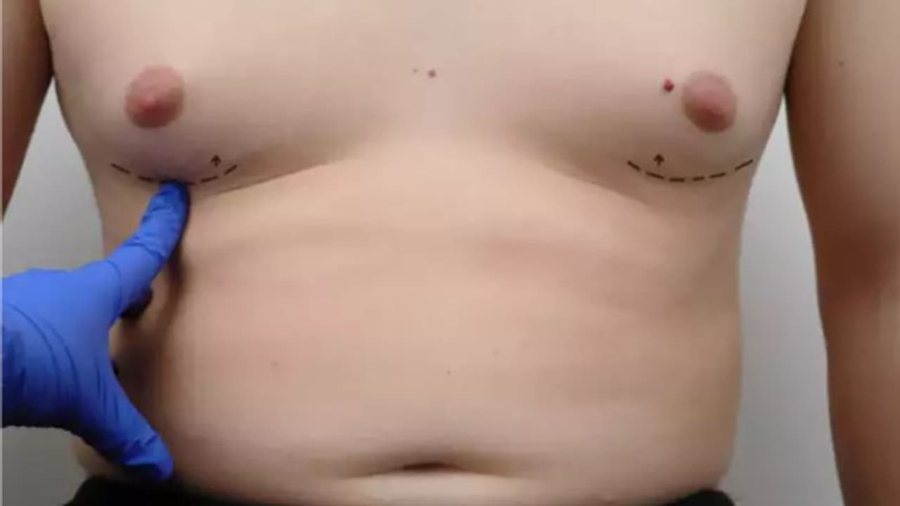 Health Tips: പുരുഷന്മാരിലെ സ്തനാർബുദം; തിരിച്ചറിയാം ഈ ലക്ഷണങ്ങളെ... Health Tips: പുരുഷന്മാരിലെ സ്തനാർബുദം; തിരിച്ചറിയാം ഈ ലക്ഷണങ്ങളെ...