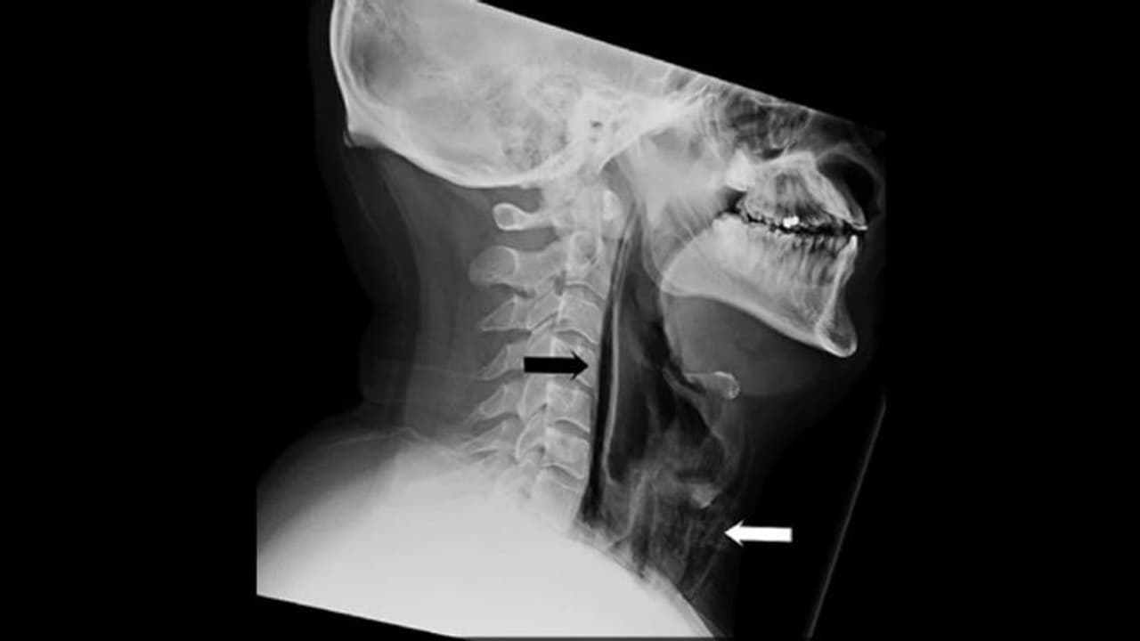 తుమ్మును ఆపుకుంటే.. శ్వాసనాళం పగిలిపోయింది... తుమ్మును ఆపుకుంటే.. శ్వాసనాళం పగిలిపోయింది...