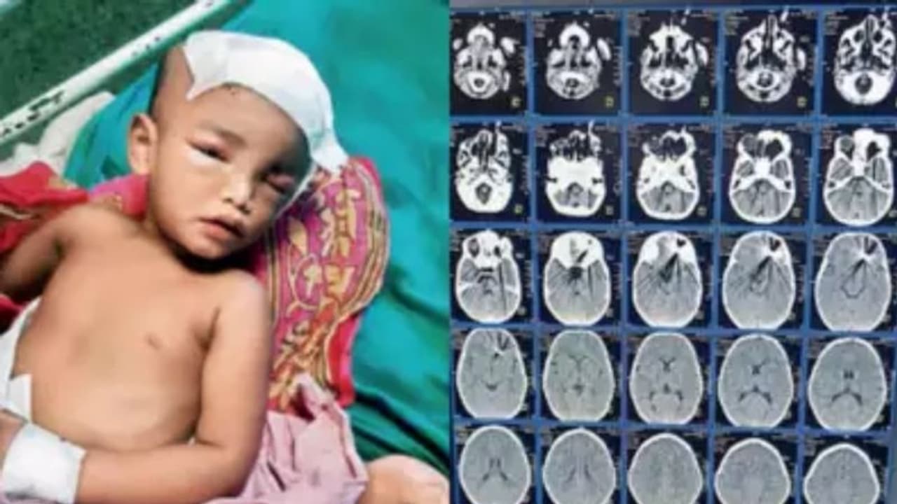 രണ്ടര വയസുകാരന്‍റെ കണ്ണിന് പുറത്തുകൂടി കത്രിക തുളഞ്ഞുകയറി; തലച്ചോറിലേക്ക് വരെയെത്തി