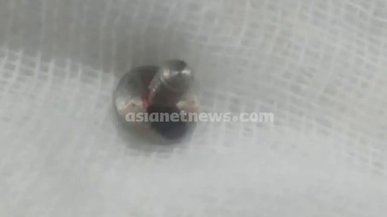 ശസ്ത്രക്രിയയിൽ പിഴവ്; സർജിക്കൽ ക്ലിപ്പ് 14 കാരന്റെ വയറ്റിൽ കുടുങ്ങി, പഴുത്തു, പുറത്തെടുത്തു: പരാതി
