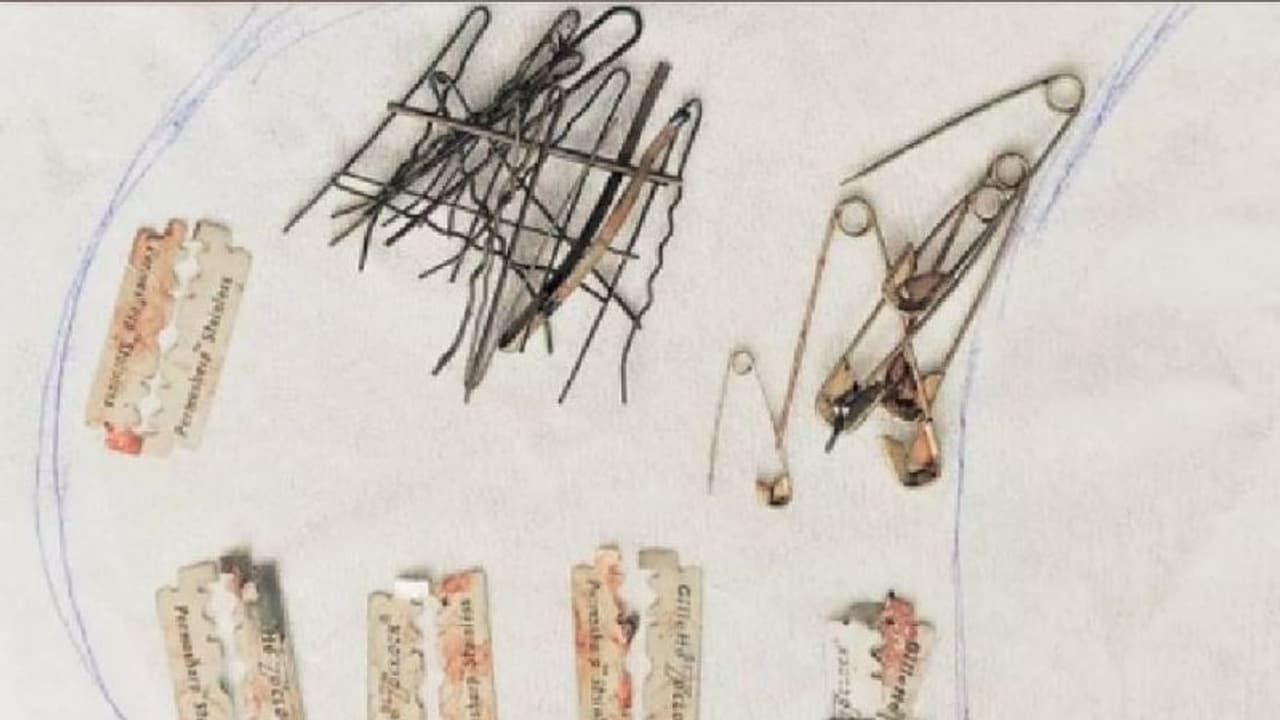 ಹೊಟ್ಟೆಯೊಳಗೇನು ಬ್ಯೂಟಿಪಾರ್ಲರ್ ಇಟ್ಕೊಂಡಿದ್ನಾ : ವ್ಯಕ್ತಿ ಹೊಟ್ಟೆಯಲ್ಲಿದ್ದ ವಸ್ತುಗಳ ನೋಡಿ ವೈದ್ಯರೇ ಶಾಕ್ ಹೊಟ್ಟೆಯೊಳಗೇನು ಬ್ಯೂಟಿಪಾರ್ಲರ್ ಇಟ್ಕೊಂಡಿದ್ನಾ : ವ್ಯಕ್ತಿ ಹೊಟ್ಟೆಯಲ್ಲಿದ್ದ ವಸ್ತುಗಳ ನೋಡಿ ವೈದ್ಯರೇ ಶಾಕ್